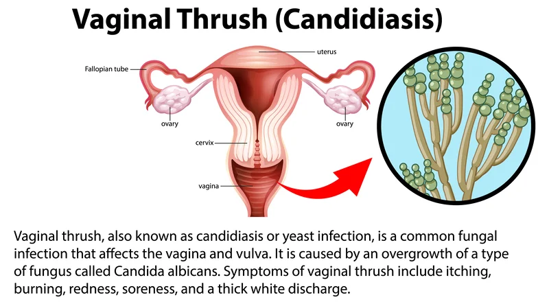 A Comprehensive Look at Vaginal Yeast Infections - Cura4U