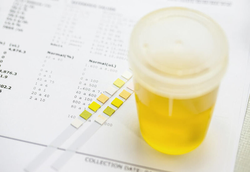 Urinalysis: What is it? How is it done? What can it detect? - Cura4U